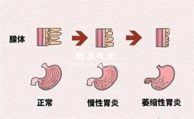 白术和陈皮泡水喝治疗胃炎吗